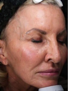 Facelift 19 After Image