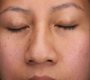 Rhinoplasty 3 After Image