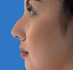 Rhinoplasty 7 After Image