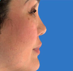 Rhinoplasty 8 After Image