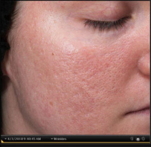 Acne Scars 3 Before Image