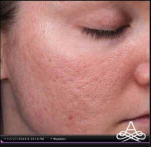 Acne Scars 3 After Image